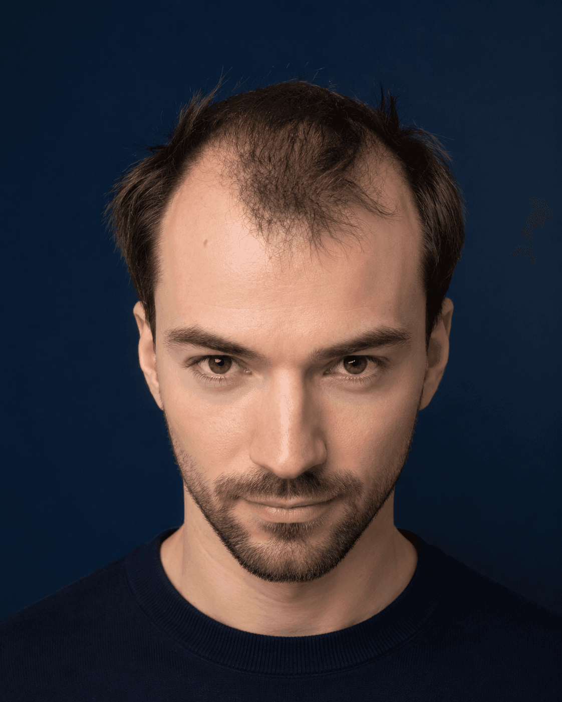 Before hair treatment — patient 1